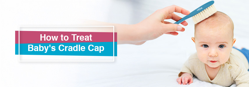 How to Treat Baby’s Cradle Cap at Home?